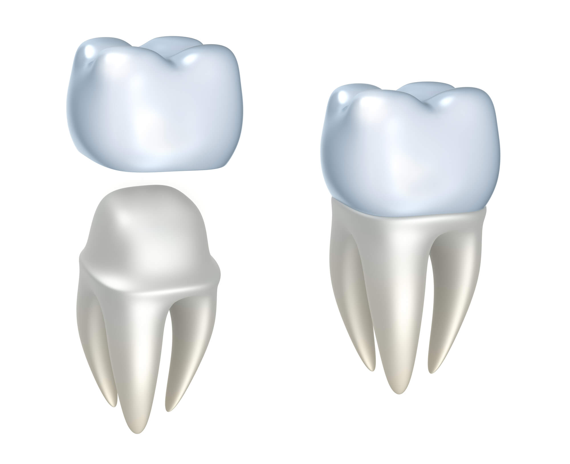 image of same day crowns in Miami